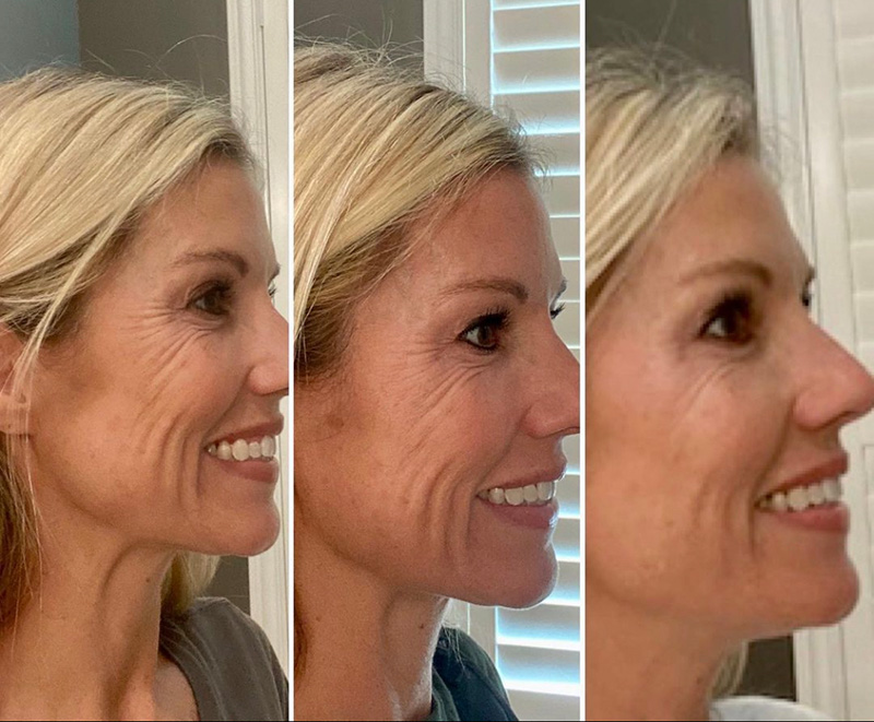 Forma Skin Tightening Before and After Results