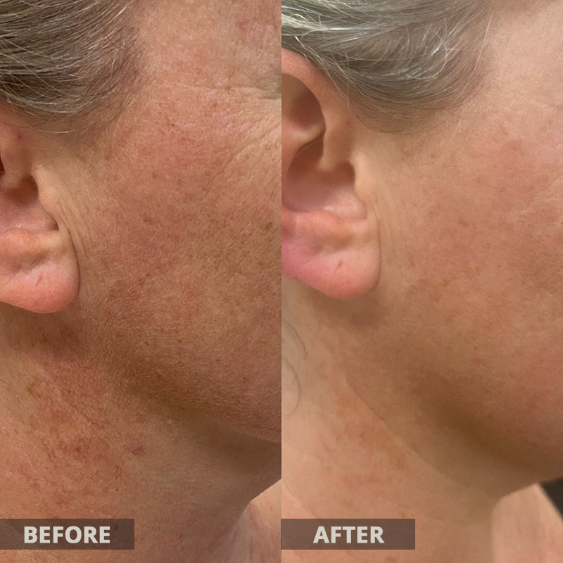 Lumecca Before and After Results