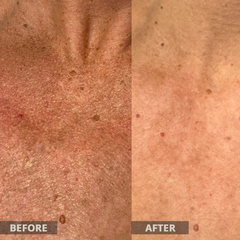 Lumecca Before and After Results