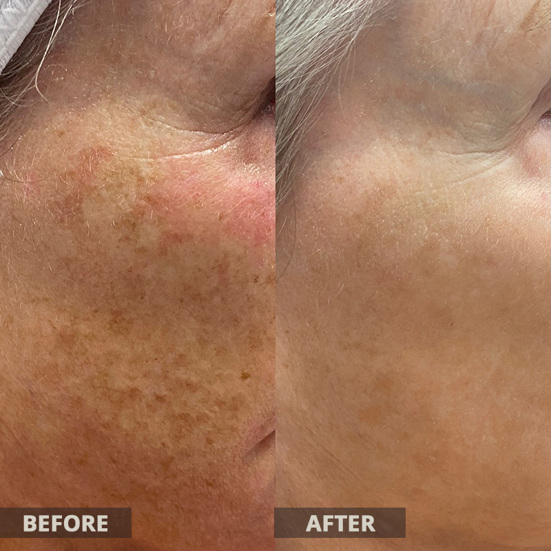 Lumecca Before and After Results