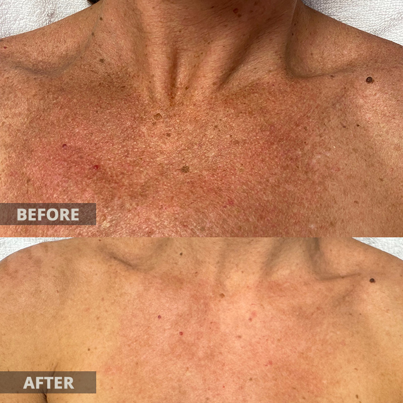 Lumecca Before and After Results