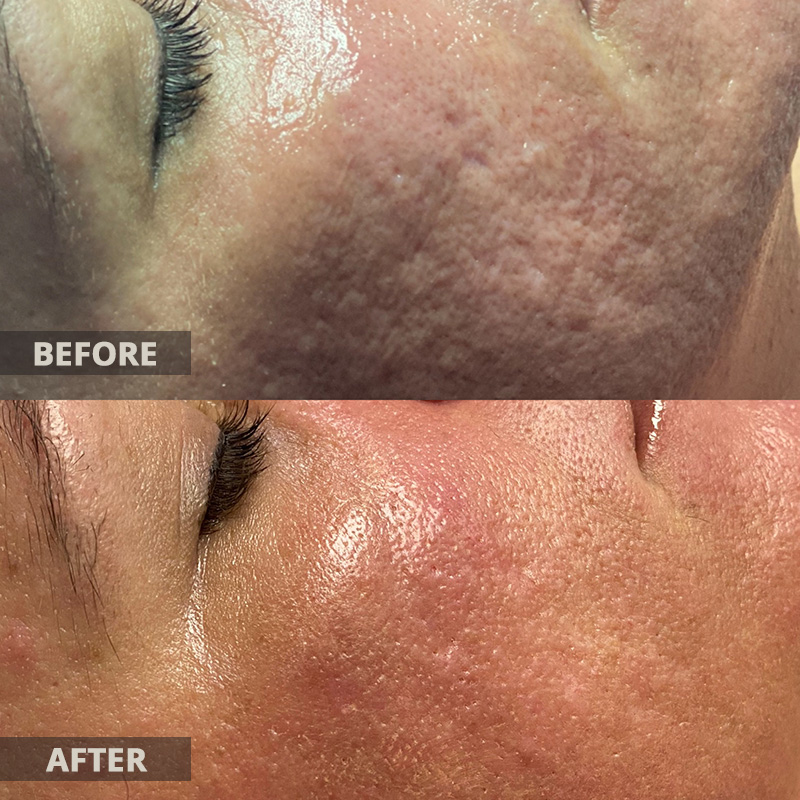 Morpheus8 Microneedling Before and After Results