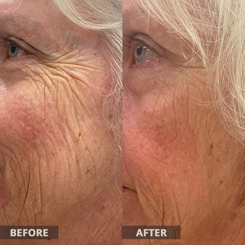 Morpheus8 Microneedling Before and After Results