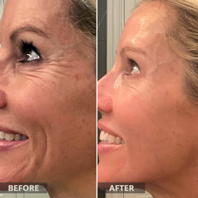 Morpheus8 Microneedling Before and After Results