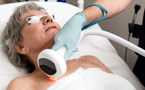 Lumecca IPL Treatment